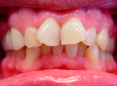 Лечение зубов