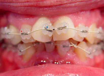 Лечение зубов