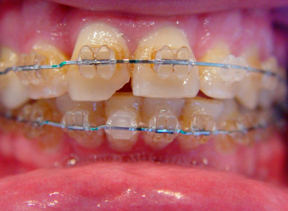 Лечение зубов