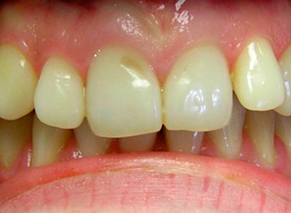 Лечение зубов