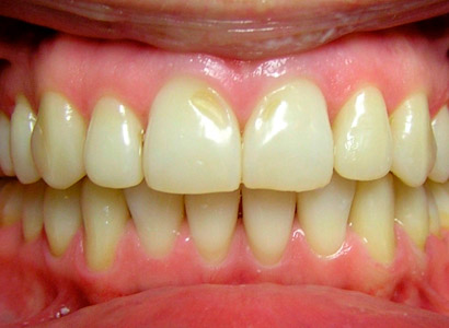 Лечение зубов