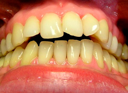 Лечение зубов