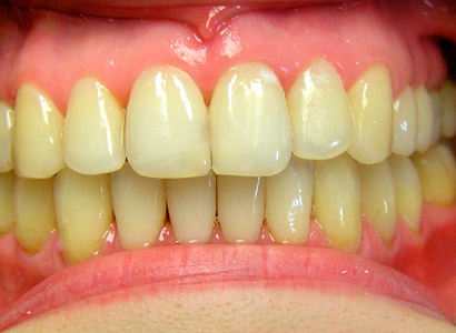 Лечение зубов