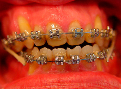 Лечение зубов