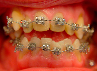 Лечение зубов