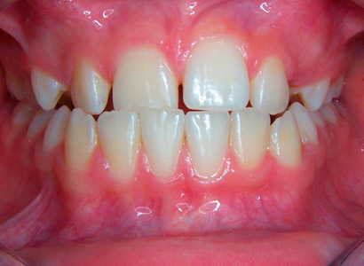 Лечение зубов