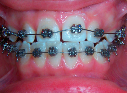 Лечение зубов