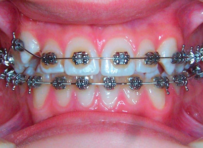 Лечение зубов