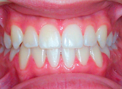 Лечение зубов